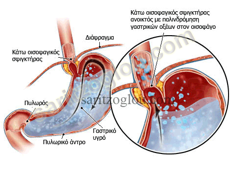 gastroesophageal reflux photo1
